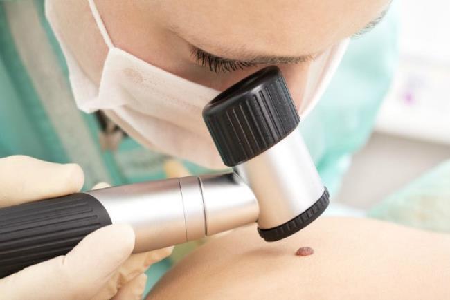 רופאה בודקת שומה לגילוי סרטן העור, אודומזו לטיפול בקרצינומה של תאי בסיס